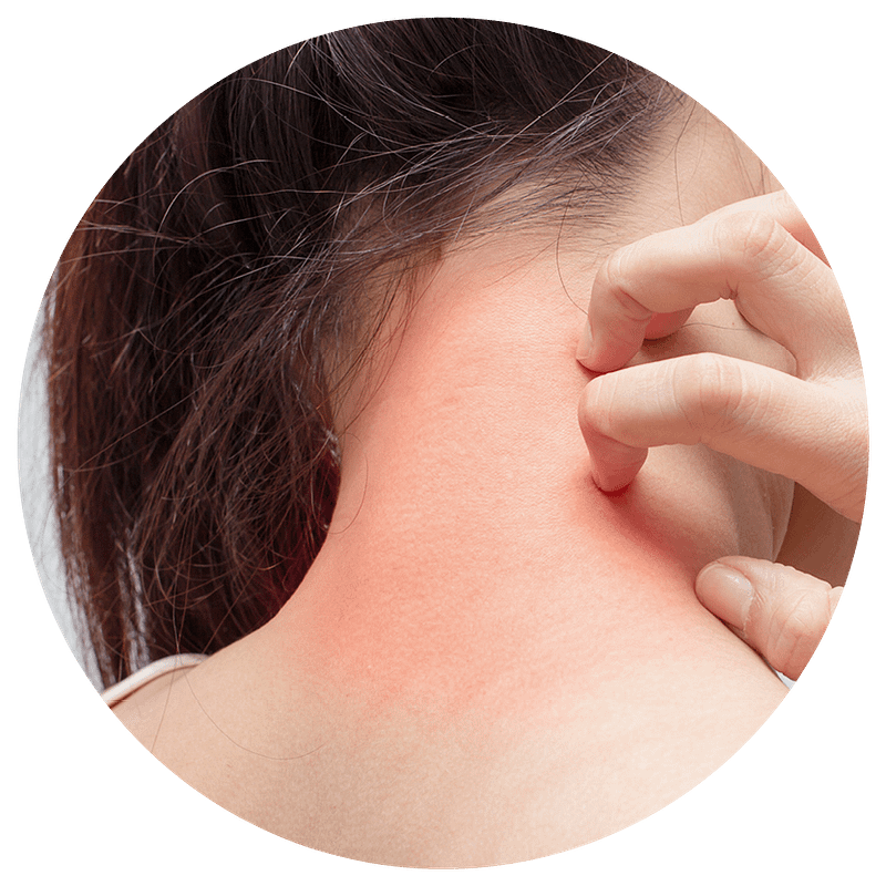 Neurodermitis am Hals